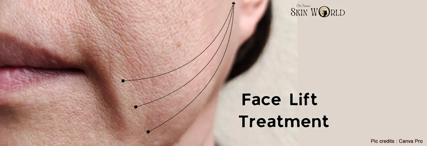 Thread Lift for Neck Sagging