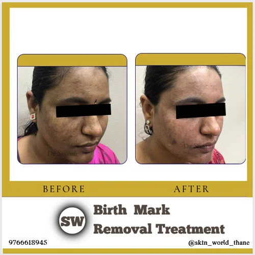 Birth Mark Removal Treatment