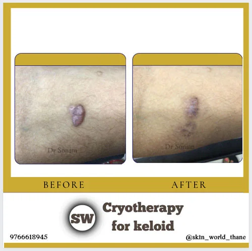 Cryotherapy for keloid