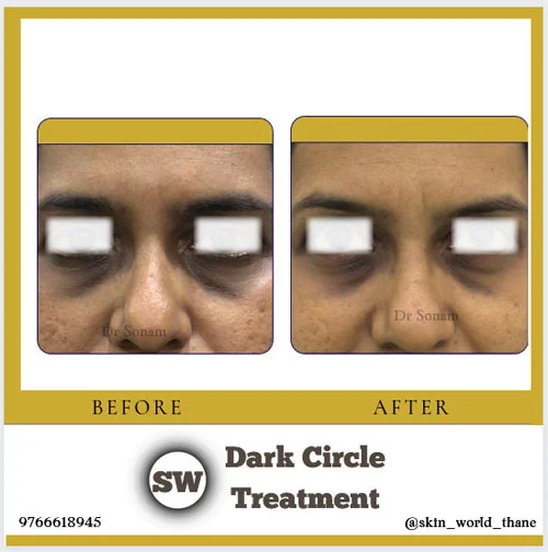 Dark Circle Treatment