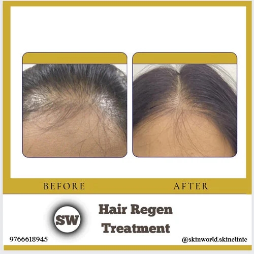 Hair Regen Treatment