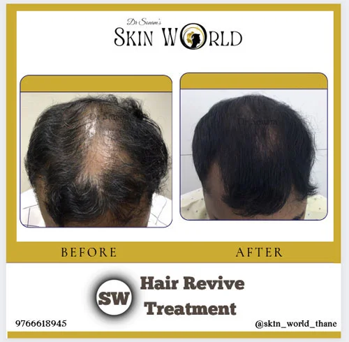 Hair Revive Treatment