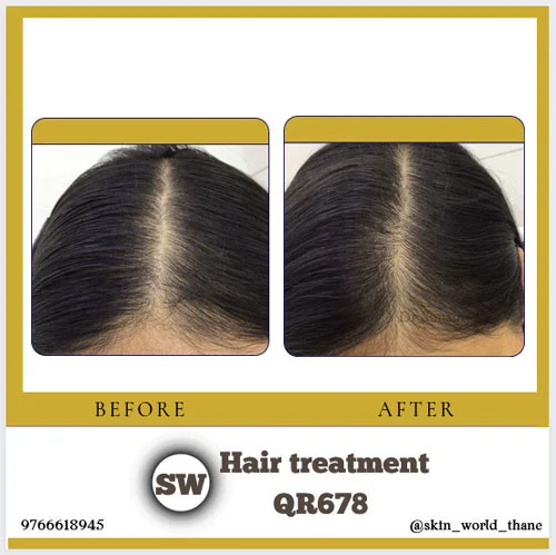 Hair Treatment QR678