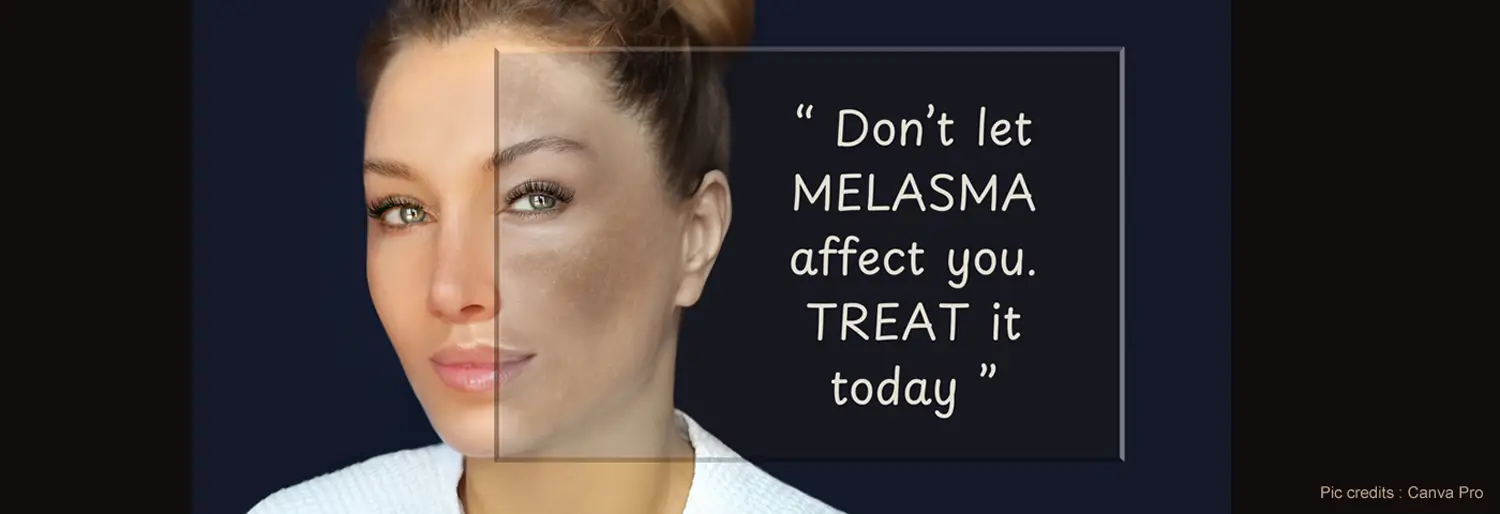 Tranexamic Acid Mesotherapy (Nuskin Treatment) for Melasma