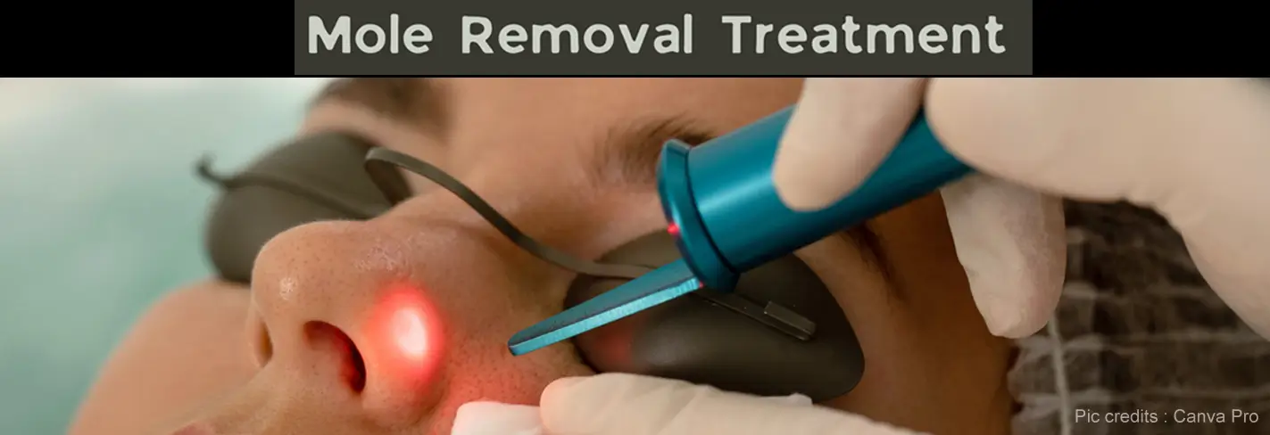 Mole Removal Treatment