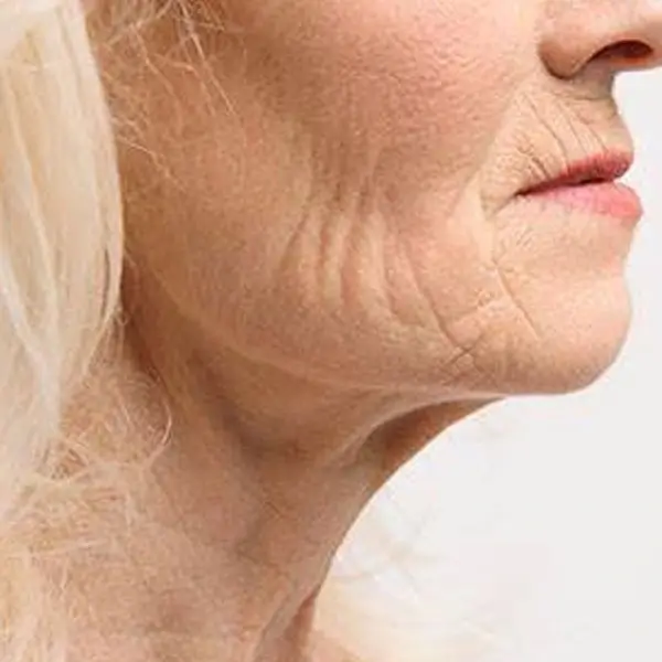 Neck aging treatments